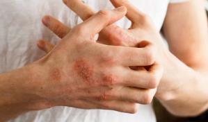 Dermatóloga  pide estar alerta ante lesiones en la piel que podrían ser lepra
