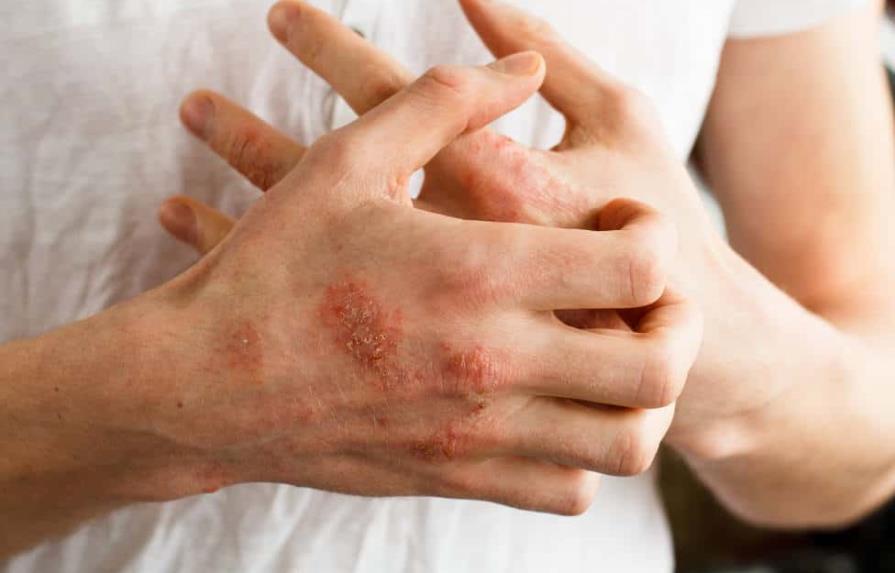 Dermatóloga  pide estar alerta ante lesiones en la piel que podrían ser lepra