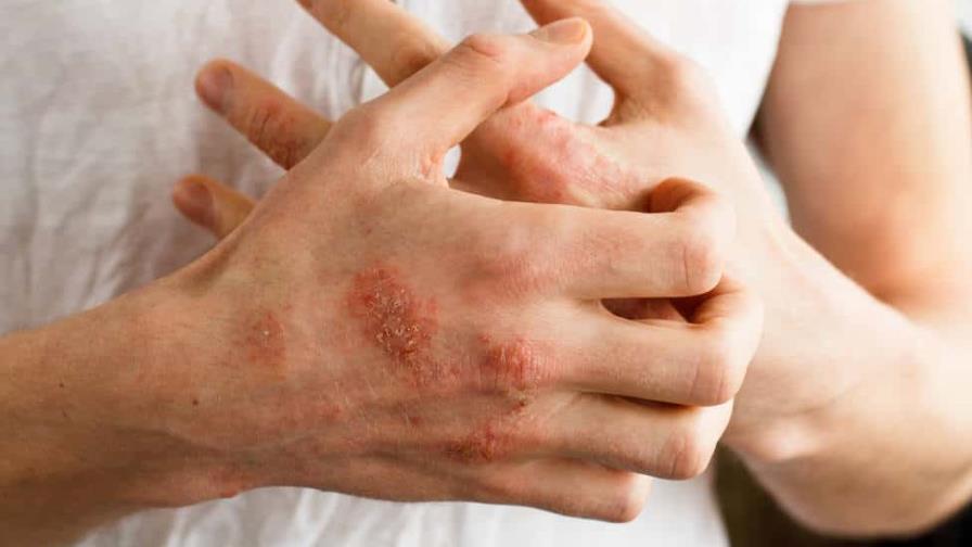 Dermatóloga  pide estar alerta ante lesiones en la piel que podrían ser lepra