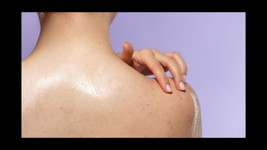 Granitos en la espalda: ¿son para preocuparse?