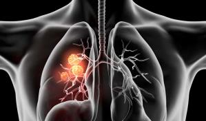 Una mol&eacute;cula para tratamiento contra el c&aacute;ncer de pulm&oacute;n llega M&eacute;xico