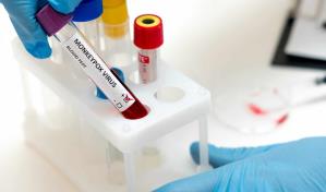 Identifican una nueva forma severa de la viruela del mono con alta mortalidad