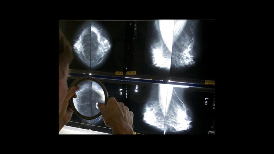 EEUU exige que se informe sobre la densidad mamaria en mastografías