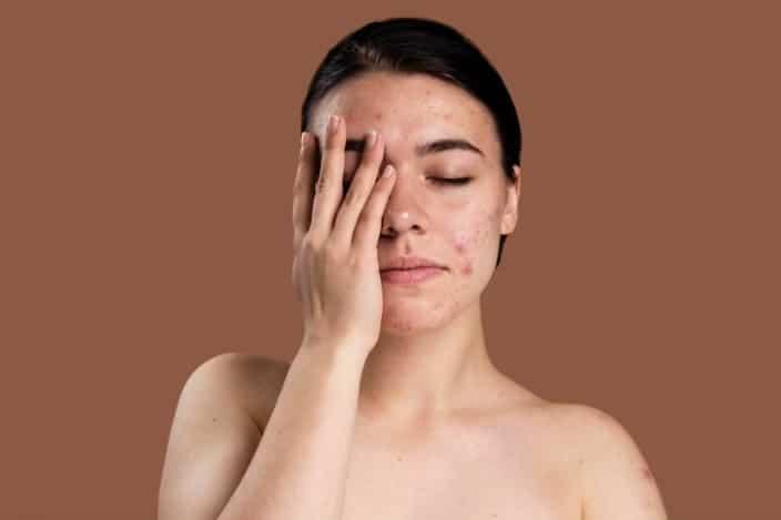 Cómo puede afectar el estrés a tu piel