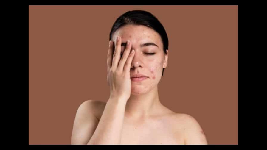 Cómo puede afectar el estrés a tu piel