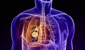 Establecen c&oacute;mo la contaminaci&oacute;n atmosf&eacute;rica puede provocar c&aacute;ncer de pulm&oacute;n
