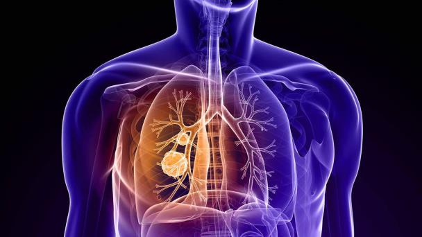 Establecen cómo la contaminación atmosférica puede provocar cáncer de pulmón