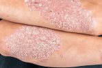 Psoriasis, ¿alguna intervención nutricional?