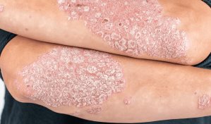 Psoriasis, ¿alguna intervención nutricional?