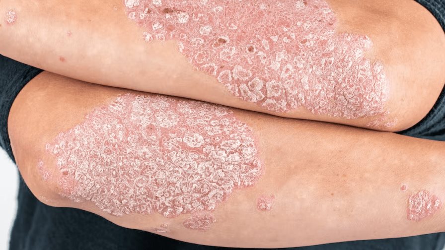 Psoriasis, ¿alguna intervención nutricional? Psoriasis, ¿alguna intervención nutricional?
