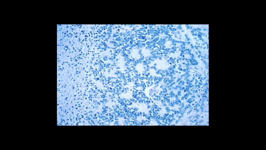 Una novedosa terapia muestra eficacia contra cáncer en niños