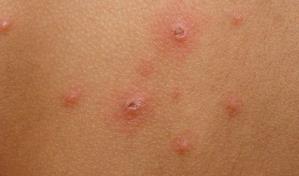 Instituto Dermatológico insta a no automedicarse para tratar la varicela