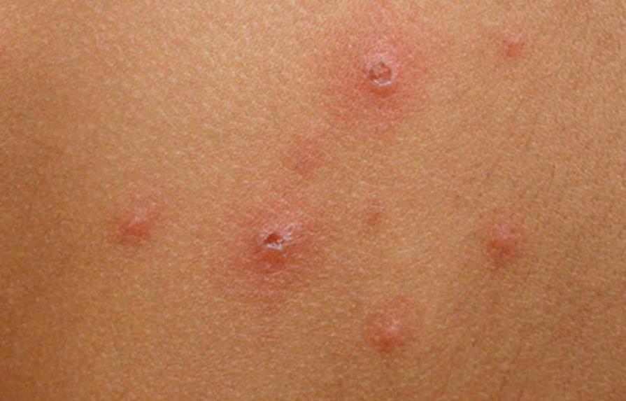 Instituto Dermatológico insta a no automedicarse para tratar la varicela
