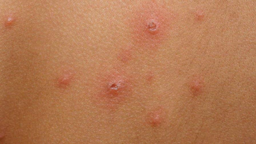 Instituto Dermatológico insta a no automedicarse para tratar la varicela