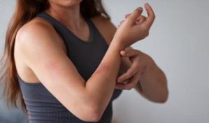 ¿Qué hacer ante una quemadura pequeña?