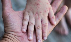 Las gotículas respiratorias son una vía de transmisión menor de la viruela símica, según la OMS