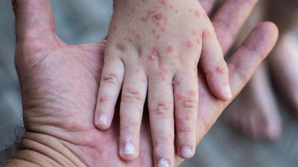 Las gotículas respiratorias son una vía de transmisión menor de la viruela símica, según la OMS