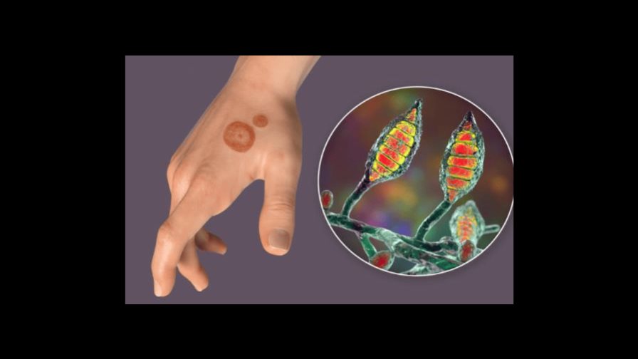 Nueva York alberga los primeros casos de una tiña resistente a medicamentos en EE.UU.