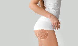 ¿Cómo reducir la celulitis y tonificar tu cuerpo?