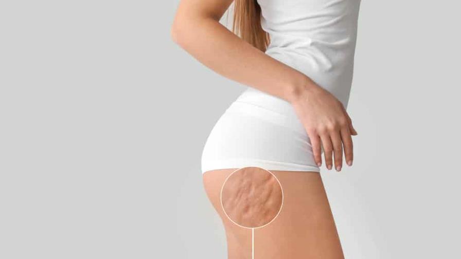 ¿Cómo reducir la celulitis y tonificar tu cuerpo? ¿Cómo reducir la celulitis y tonificar tu cuerpo?