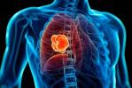 Un nuevo tratamiento aumenta la supervivencia en pacientes con cáncer de pulmón