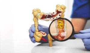 La terapia contra el cáncer de recto consigue dar la espalda a la radiación