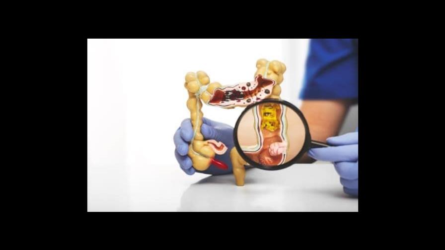 La terapia contra el cáncer de recto consigue dar la espalda a la radiación