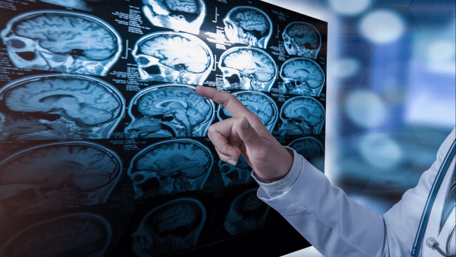 Una pastilla consigue detener varios años el avance de un tumor cerebral maligno Una pastilla consigue detener varios años el avance de un tumor cerebral maligno