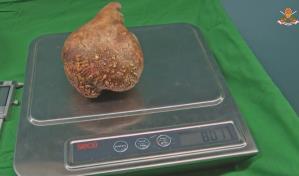 Extirpan a un paciente en Sri Lanka el cálculo renal más grande del mundo