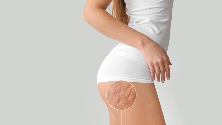 ¿Cómo prevenir y tratar la celulitis?