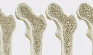 &iquest;C&oacute;mo prevenir la osteoporosis?