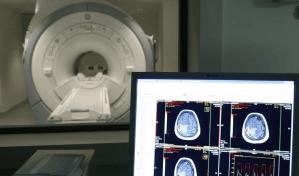 Un estudio demuestra que la región de la amígdala cerebral es clave en el alzhéimer