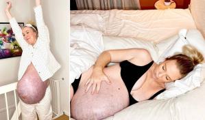 La impresionante barriga de una embarazada que esperaba trillizos