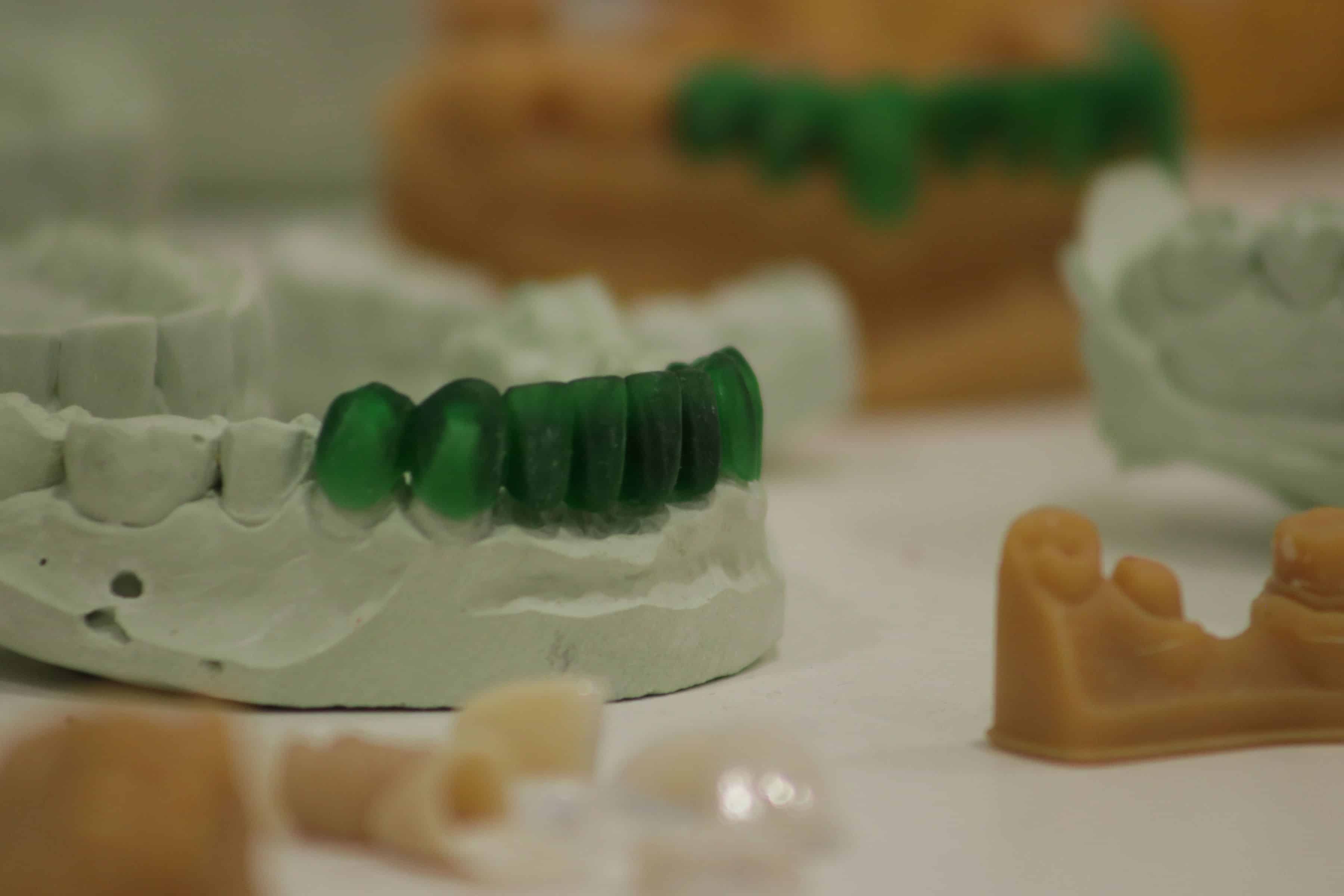 Los retenedores transparentes ayudan a enderezar la dentadura.