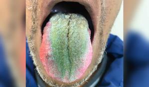 Lengua verde y peluda en hombre de Ohio por fumar y tomar antibióticos