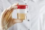 Una muestra de orina puede servir para diagnosticar el cáncer de endometrio Una muestra de orina puede servir para diagnosticar el cáncer de endometrio