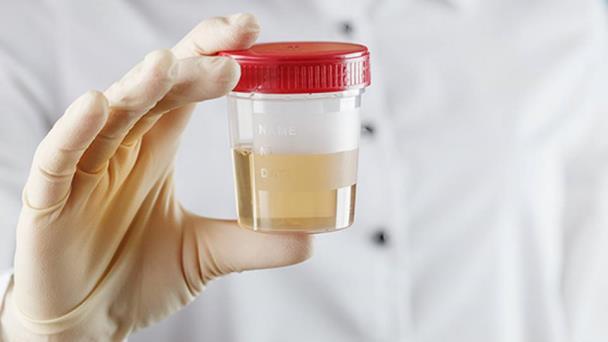 Una muestra de orina puede servir para diagnosticar el cáncer de endometrio