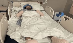 Amputan brazos y parte de los pies a un hombre por mordedura de una pulga