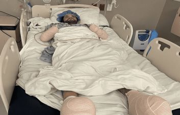 Amputan brazos y parte de los pies a un hombre por mordedura de una pulga