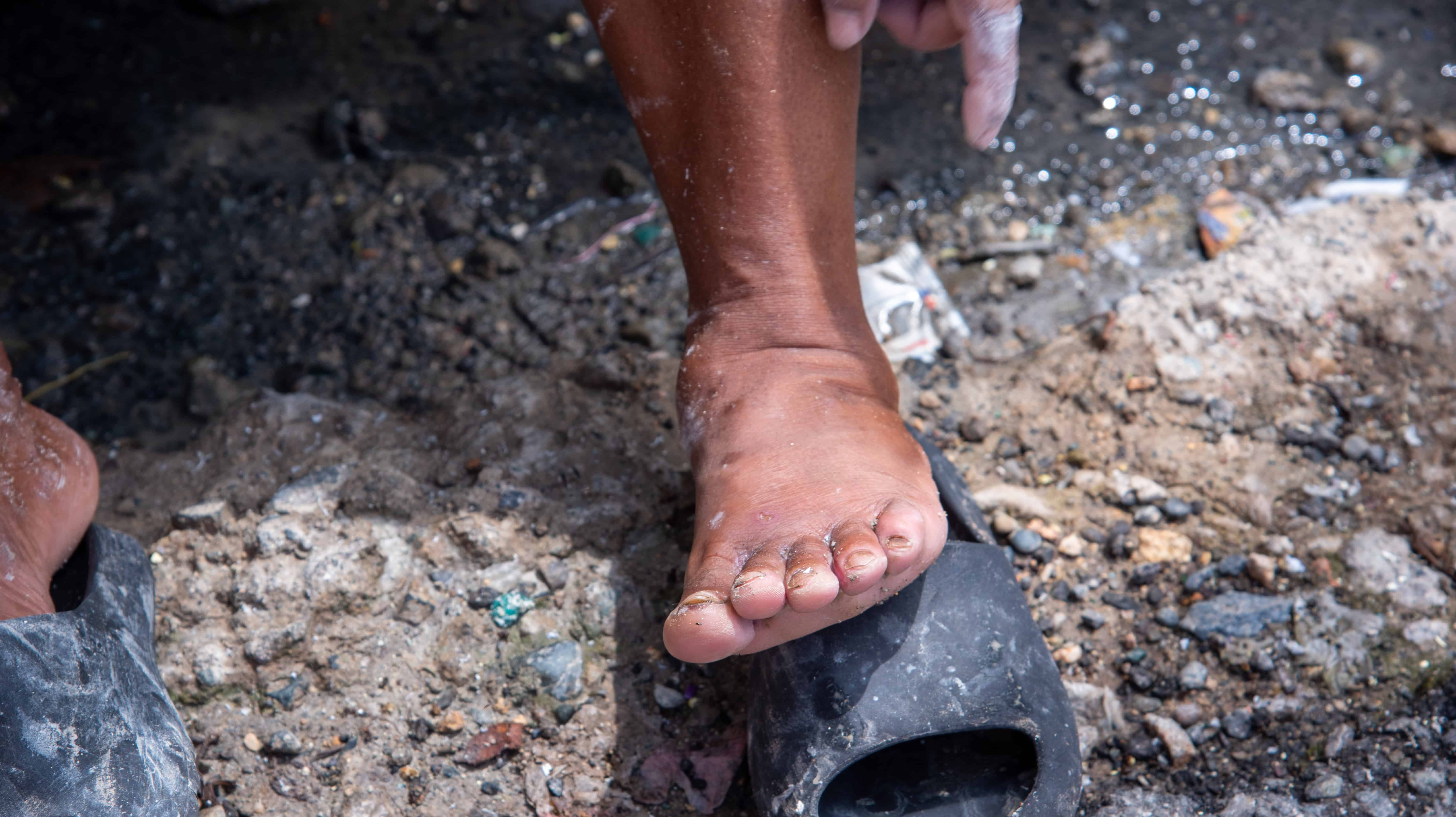 Algunas personas presentan problemas  de infección en los pies por el agua contaminada.