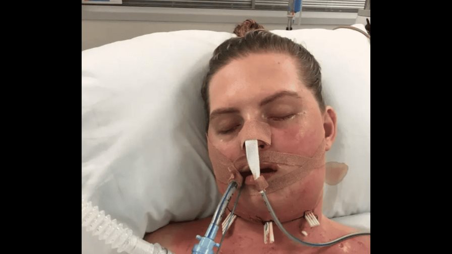 Infección en una muela del juicio deja en coma a una joven de 27 años en Australia