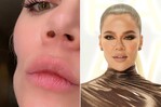 Khloé Kardashian muestra su cicatriz por cáncer de piel Khloé Kardashian muestra su cicatriz por cáncer de piel