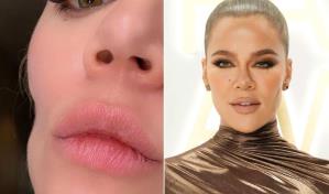Khloé Kardashian muestra su cicatriz por cáncer de piel
