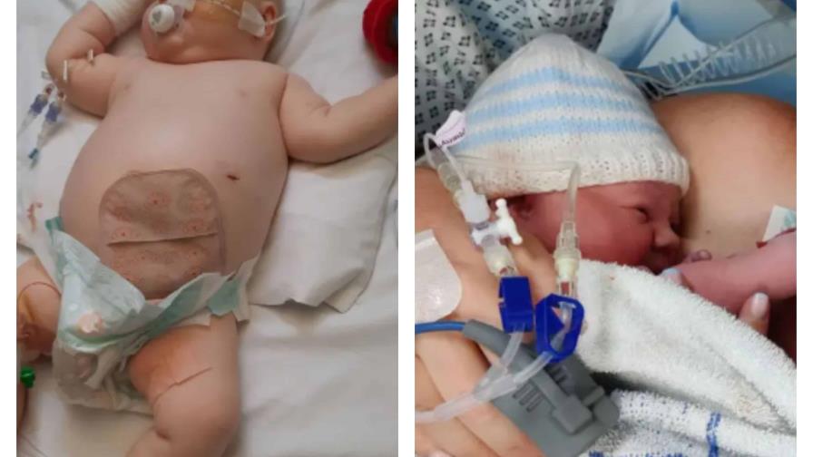 Bebé que nació sin ano busca una sexta cirugía que le salve la vida