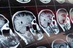 Científicos de Hong Kong crean herramienta IA para anticipar pronóstico de tumor cerebral Científicos de Hong Kong crean herramienta IA para anticipar pronóstico de tumor cerebral