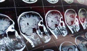 Científicos de Hong Kong crean herramienta IA para anticipar pronóstico de tumor cerebral