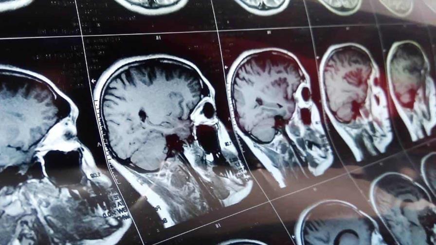 Científicos de Hong Kong crean herramienta IA para anticipar pronóstico de tumor cerebral
