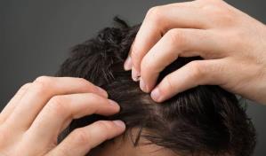 Cuidado del cuero cabelludo y prevenci&oacute;n de la caspa