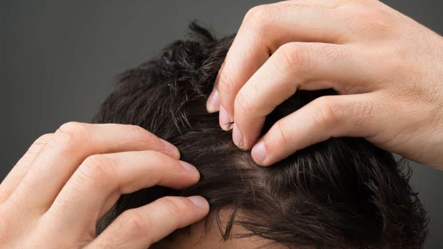 Cuidado del cuero cabelludo y prevención de la caspa