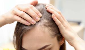 Menos común, pero no imposible: calvicie en mujeres